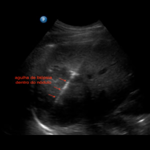 Biópsia guiada por ultrassom