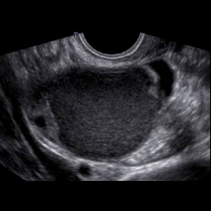 Ultrassonografia com preparo intestinal para endometriose