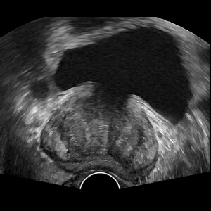 Ultrassonografia da Próstata