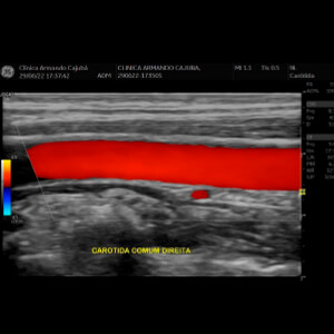 Ultrassonografia Doppler