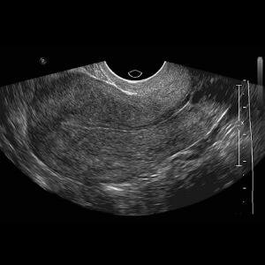 Ultrassonografia transvaginal